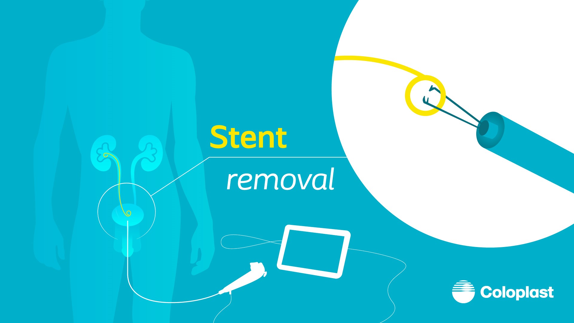 Challenges around Double-J stent removal