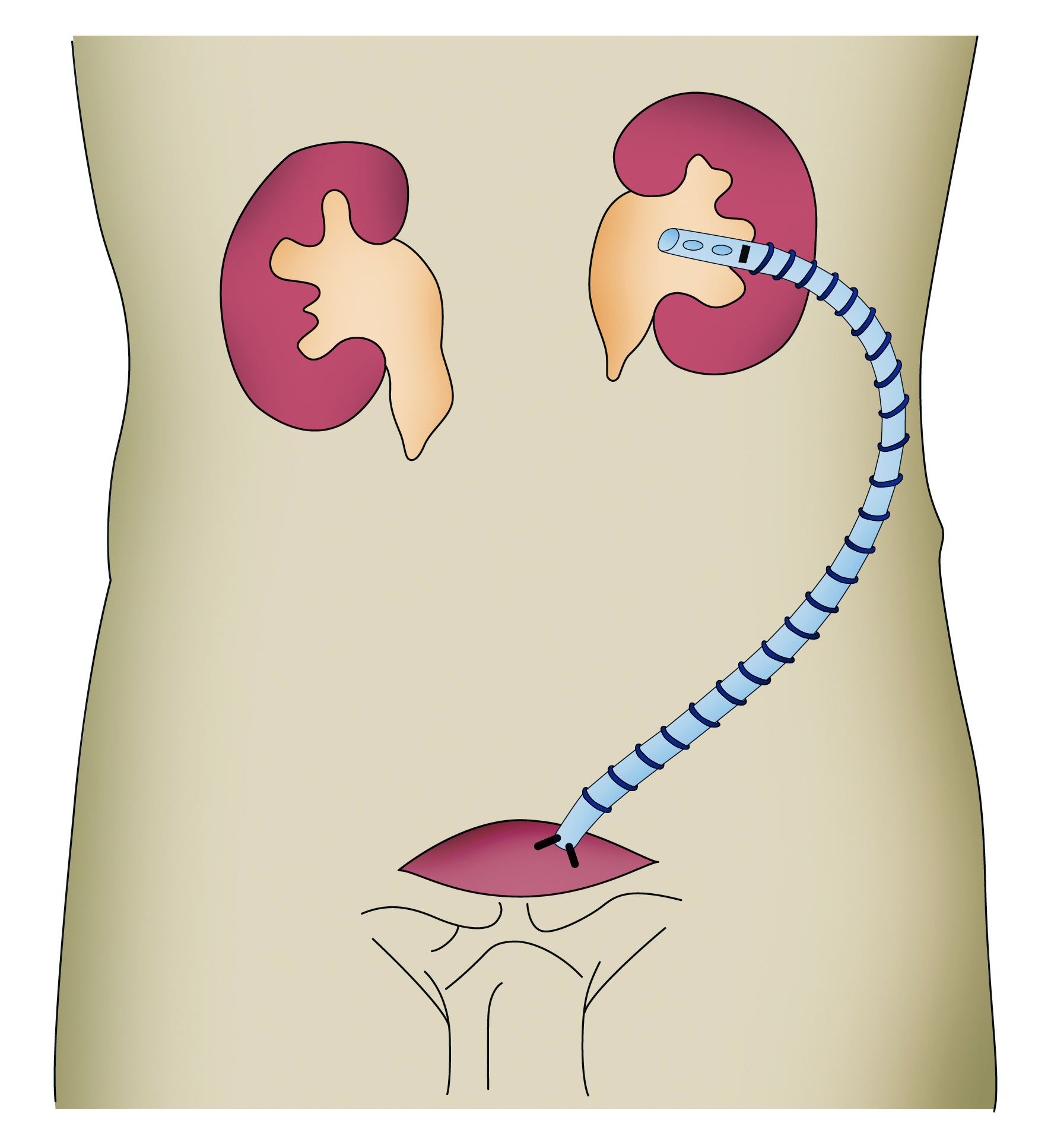 Detour procedure_Coloplast